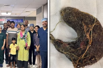 Doctors at Civil Hospital Ahmedabad pose with the young patient and his family after a successful surgery, alongside the rare trichobezoar mass of hair and grass removed from the child’s stomach.
