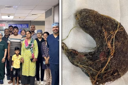 Doctors at Civil Hospital Ahmedabad pose with the young patient and his family after a successful surgery, alongside the rare trichobezoar mass of hair and grass removed from the child’s stomach.