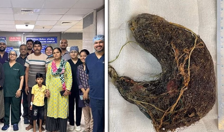Doctors at Civil Hospital Ahmedabad pose with the young patient and his family after a successful surgery, alongside the rare trichobezoar mass of hair and grass removed from the child’s stomach.